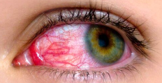  ویروس کرونا می تواند باعث درد، قرمزی، ضعیف شدن چشم شود
