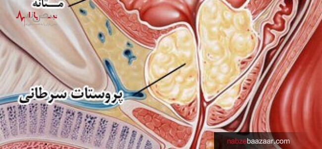 روش های تشخیص نوع سرطان پروستات