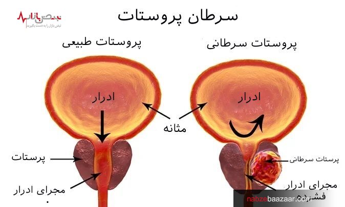 روش های تشخیص نوع سرطان پروستات