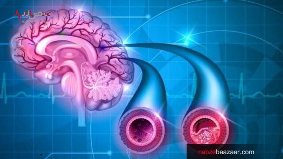 پیش بینی علائم زوال عقل با استفاده از اسکن مغز