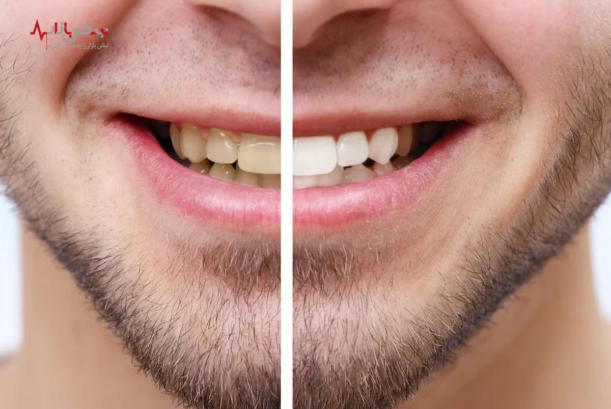 رازهای پنهان پشت سفیدی دندان‌ها و راهکارهای شگفت‌ انگیز برای دستیابی به لبخندی درخشان