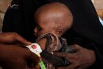 نوزاد مبتلا به سوء تغذیه در سومالی/ خبرگزاری فرانسه 